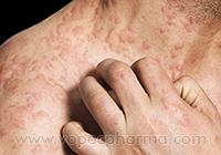  Home Remedies for Psoriasis